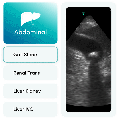 Vave Phased-Array Wireless Ultrasound