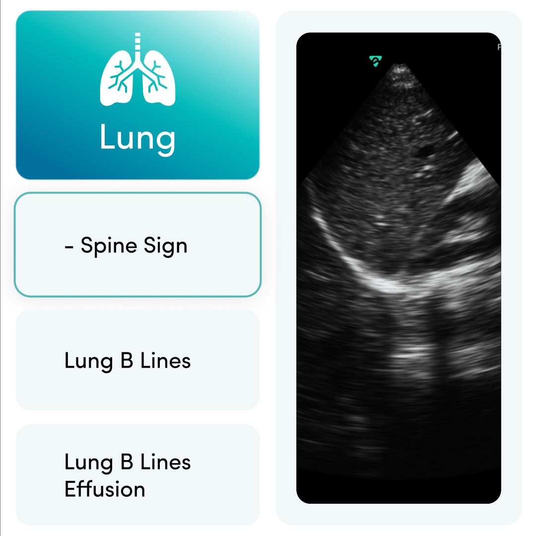 Vave Phased-Array Wireless Ultrasound